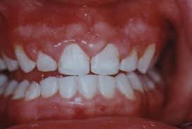 gums overgrow boundaries in many mouth breathers